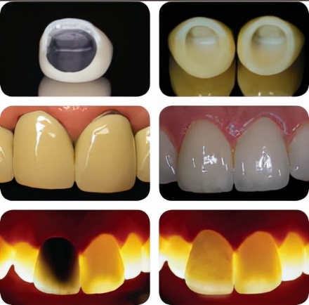 烤瓷牙好处多，但我却不推荐你做，为什么？