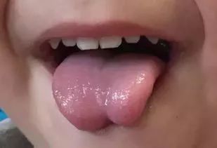 婴儿舌头破皮图片图片