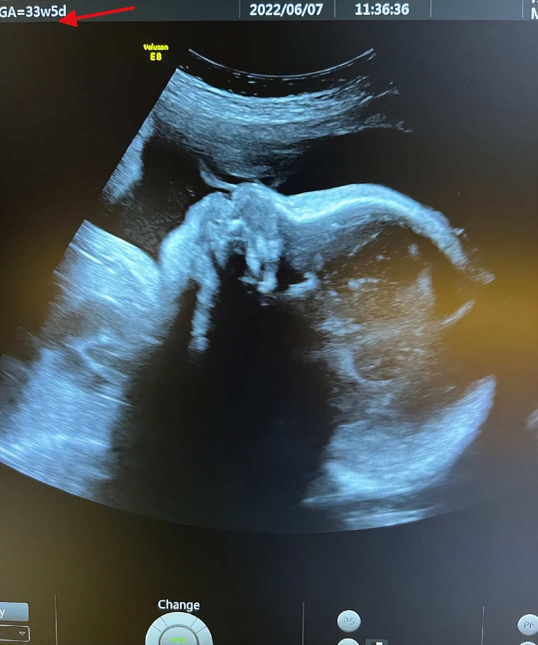 陈燃预产期将至，晒B超照曝二胎是男孩，提前公布宝宝性别惹争议