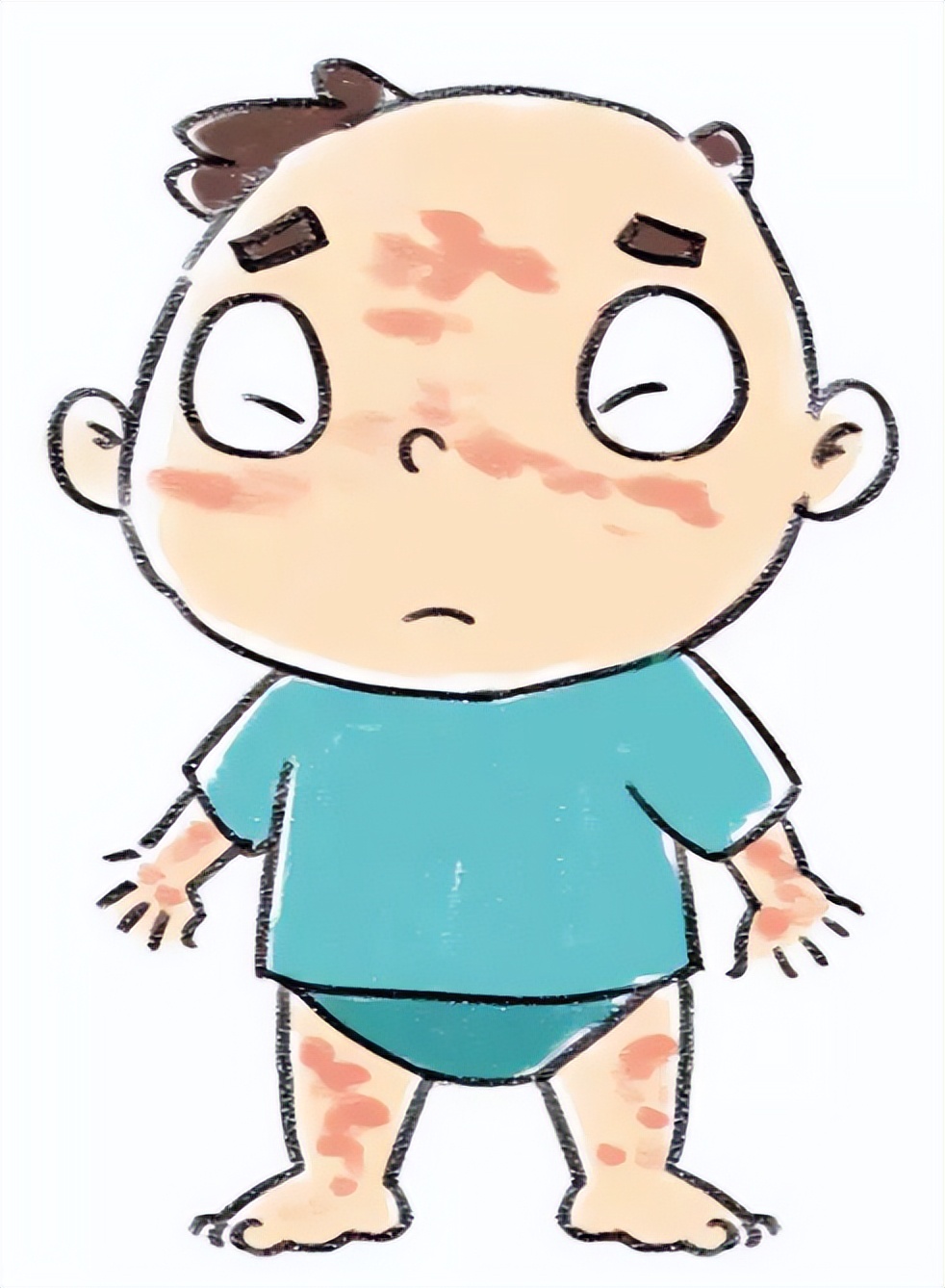 皮肤过敏的症状图片(荨麻疹奇痒难忍) - 赤虎壹号