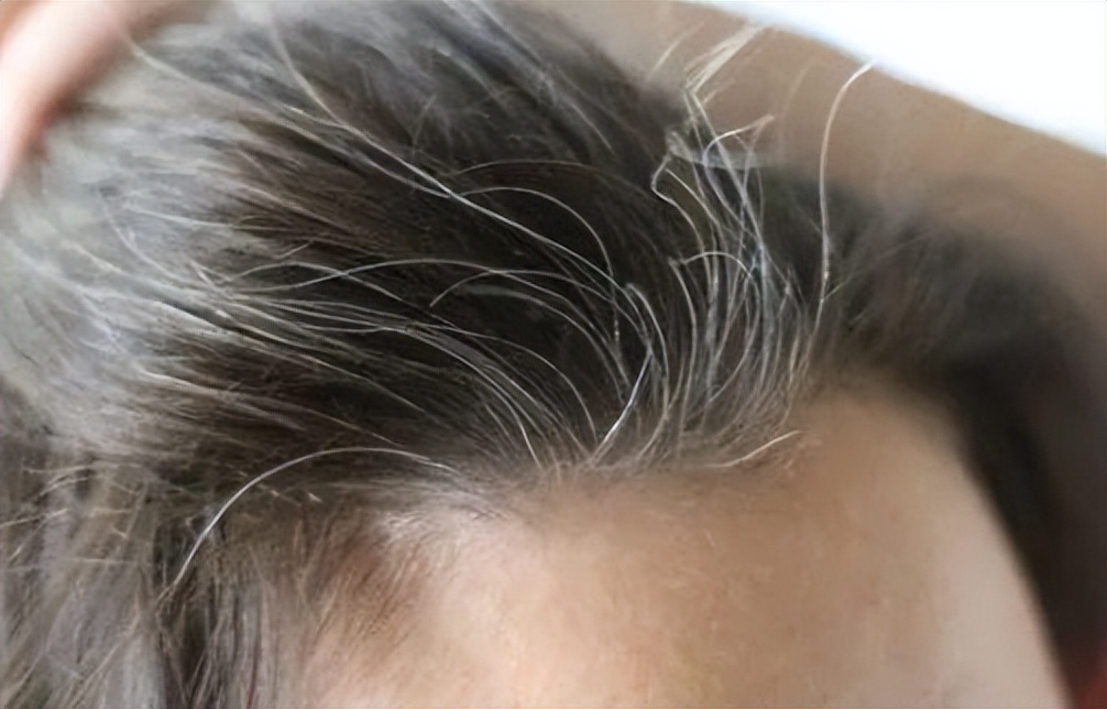 食物与白头发的生长也有较大的关系,如果营养不良的情况下,缺少了