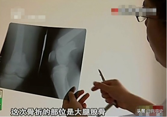 真实故事：山东17岁男孩无痛感汗腺，自我伤害博痛觉，父母泪崩