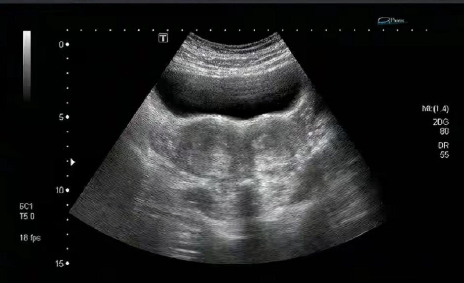 故事:陕西37岁女子怀孕5个月,B超检测胎儿离奇"消失",结果如何了?