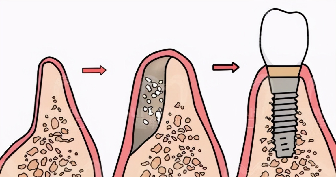 「牙齿那些事儿」No.70丨种植牙前植入骨粉会发低热，这是为什么