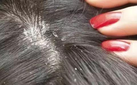 为啥头皮老是长“疙瘩”和“脓包”？医生：或许与这6个因素有关