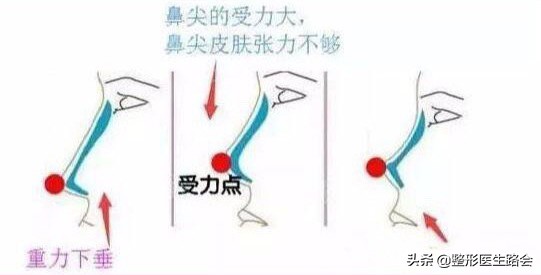 怎么样让鼻子变高(25岁“硅胶隆鼻”歪斜、穿出！修复3个月，说几句大家不知道的)