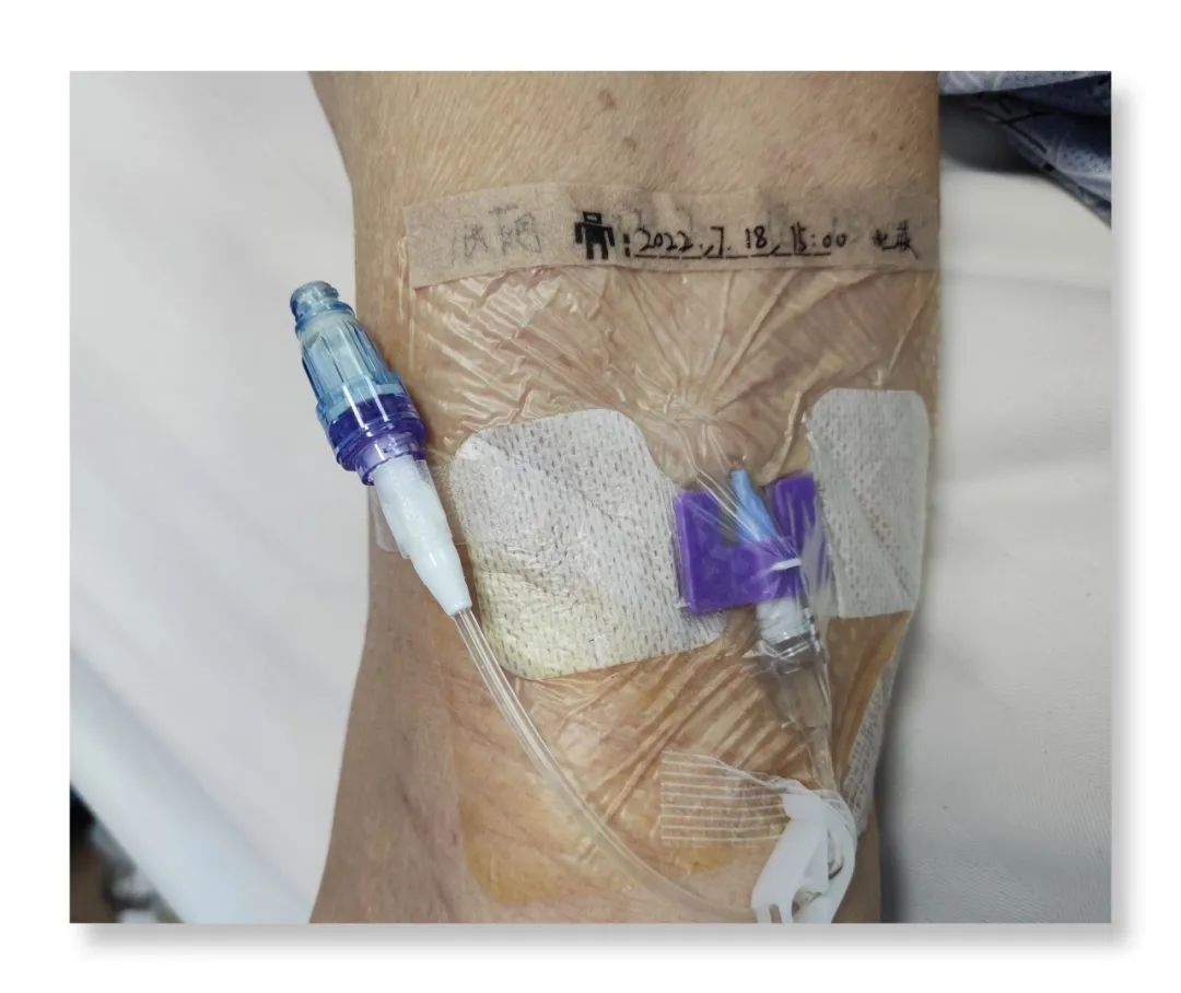 渭南市第二医院普通外科:迷你中长导管 为患者带来福音