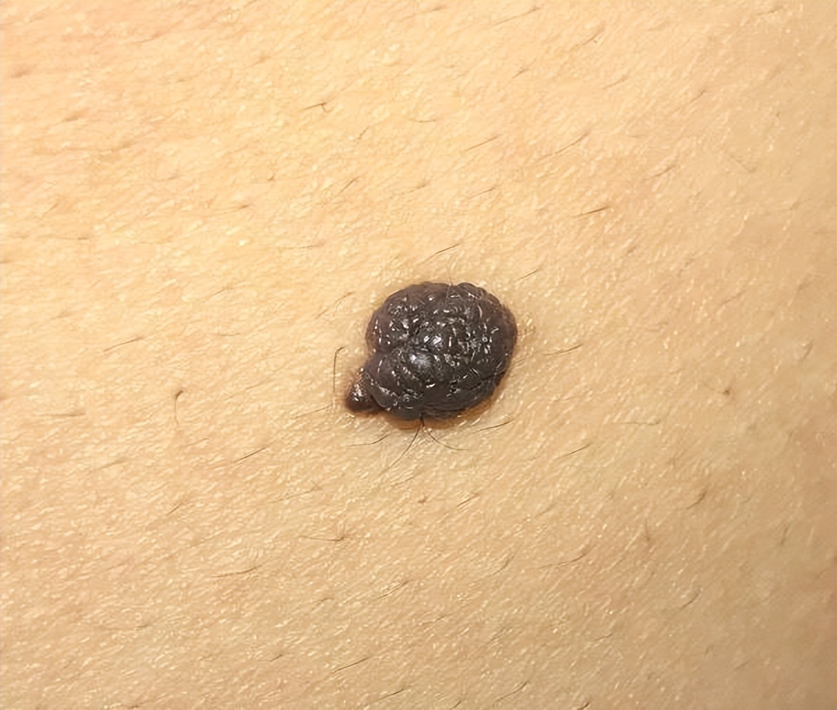 医生提醒:若黑痣长在这4个部位,要密切关注,及早做检查