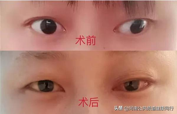 “废用性斜视矫正+筋膜固定术”让患者重拾自信——河南省直第三人民医院