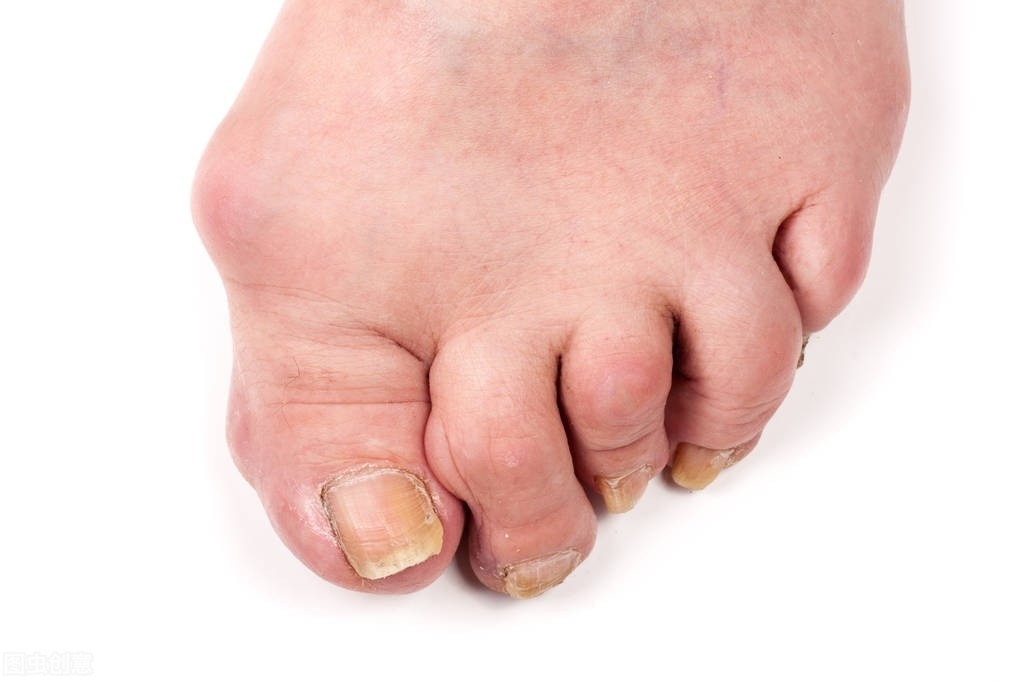 大脚趾偏斜骨头凸出,这种情况要不要治?要看有没有这两个特征