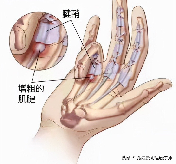 中老年女性常手指疼痛、肿胀，是腱鞘炎吗？该怎么办？告知您