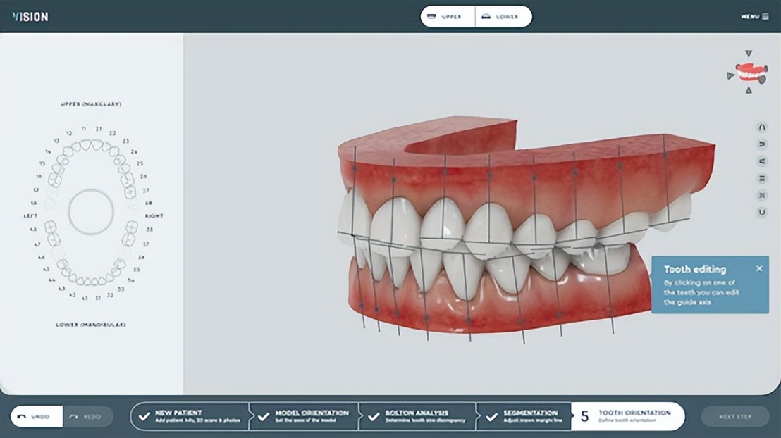 3D打印在齿科领域的应用：几乎所有的产品都使用了3D打印技术