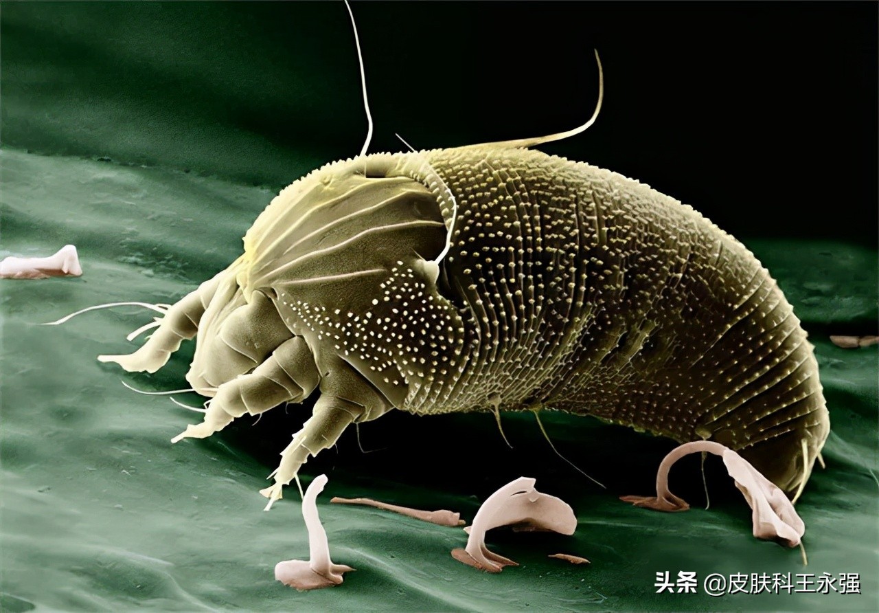疥螨到底是什么?感染后有何症状?这2种传播途径,男女都要小心
