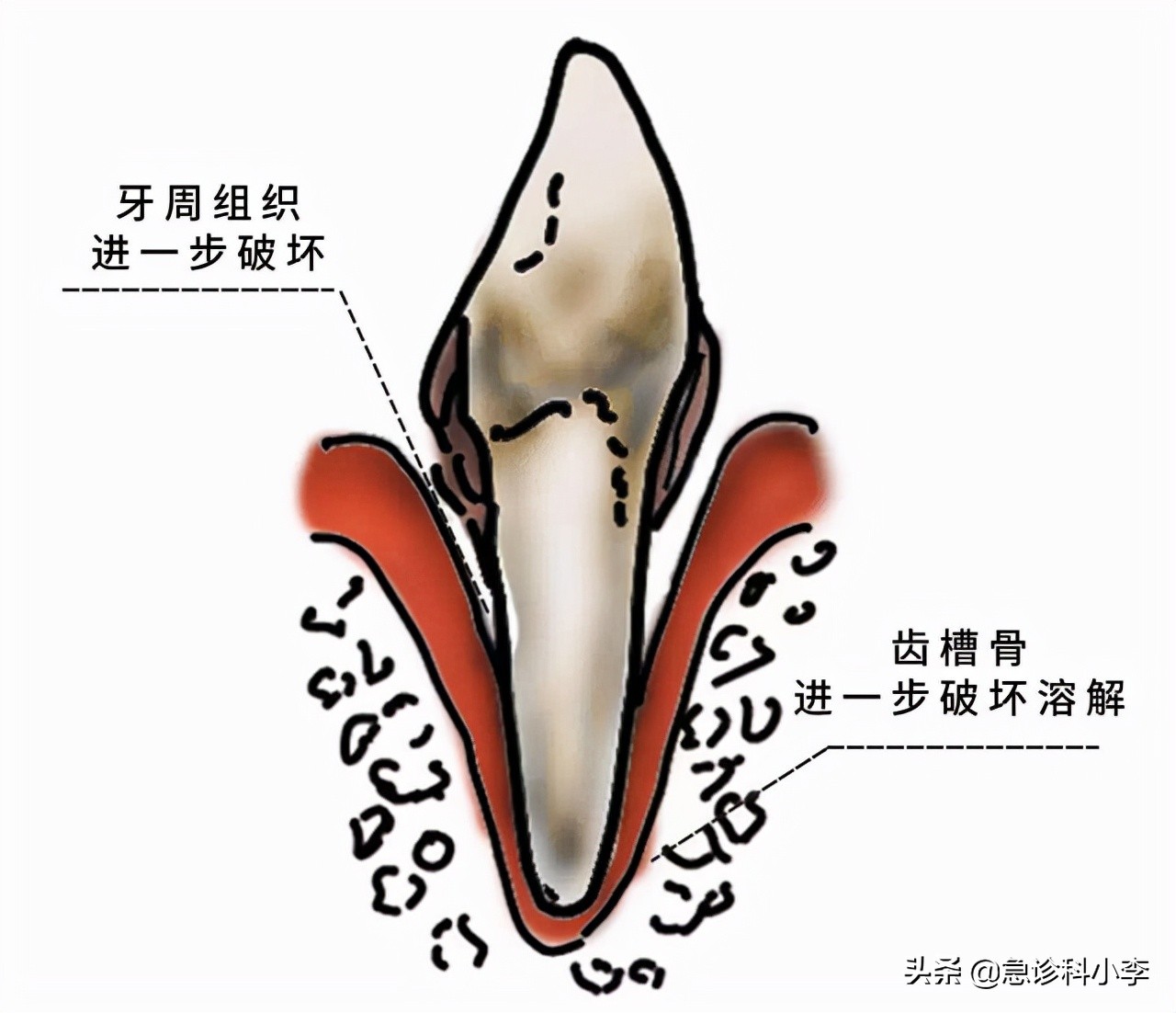 牙缝里的牙结石，如何清除干净？3个办法是不少人的选择