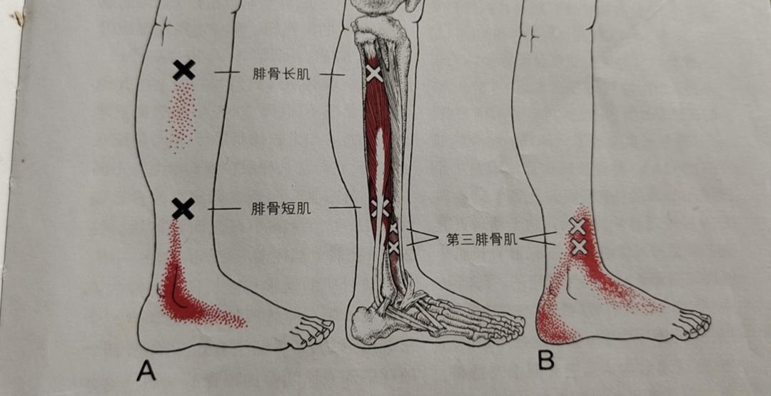 神奇的螺旋链：急性右踝疼痛的筋膜治疗