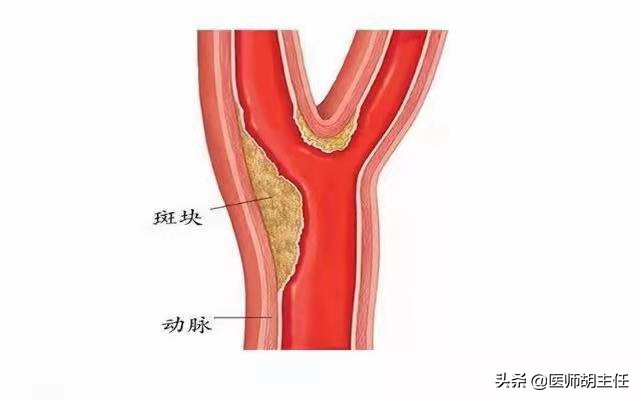 55岁大叔“斑块”消失，他坚持的3大习惯值得借鉴