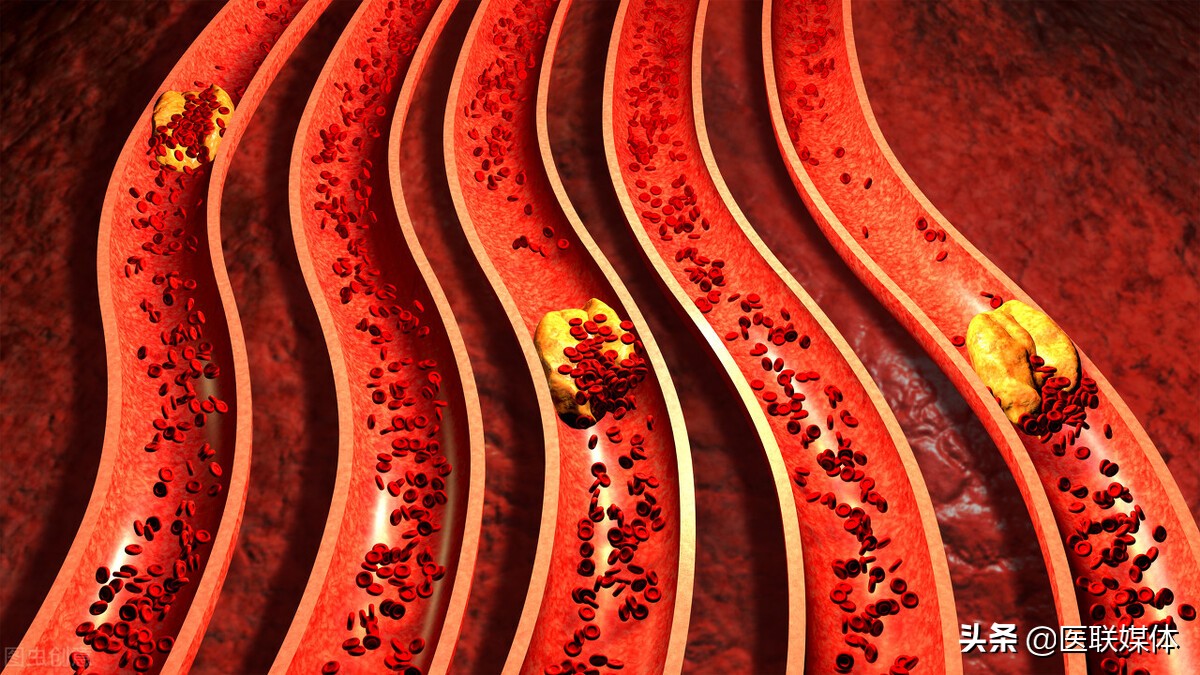 高血脂会引起脑部病变？少吃3种食物，别让脑血管也堵住了