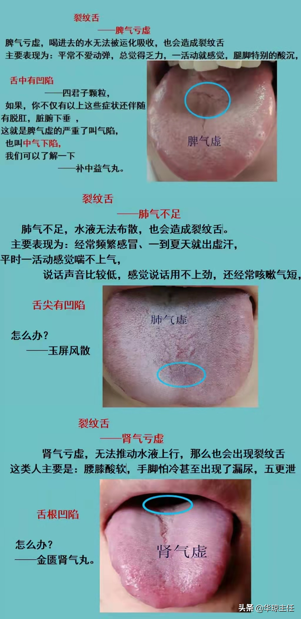 舌有裂纹就是阴虚？四种裂纹舌，十种舌象看看你是属于哪一种？