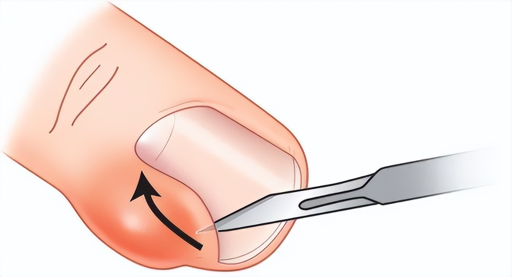 踢足球会引起甲沟炎吗(治甲沟炎，必须拔指甲？医生教你一招，在家就能缓解)
