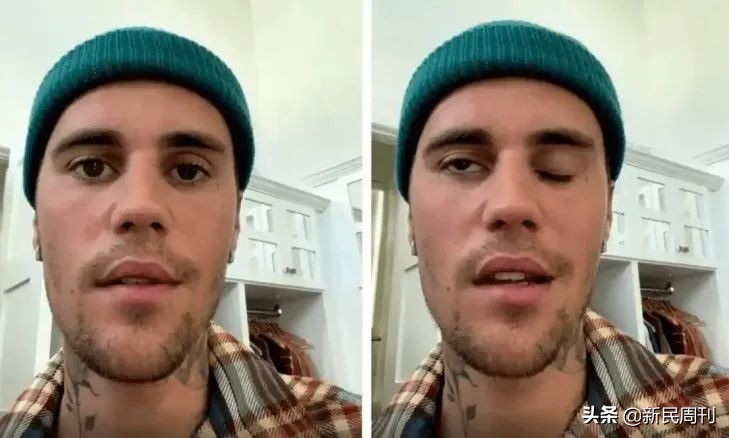 良医 | 比伯面瘫，这么好看的脸还能治好吗？