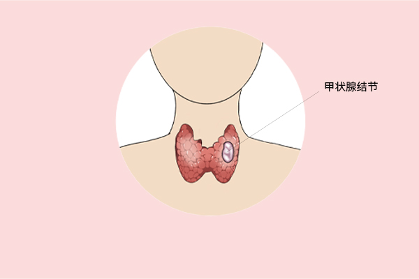 年仅19岁，查出甲状腺结节，要不要手术切除？参考3件事再做决定