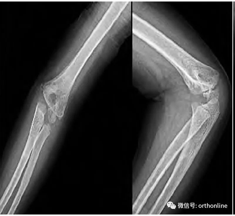 儿童肱骨髁上骨折合并同侧孟氏骨折1例报道