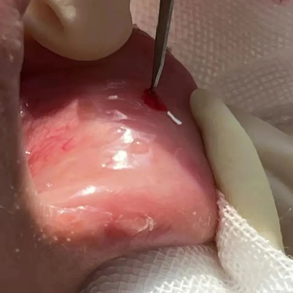 仁医新术｜口干舌燥也能治？改良式微创唇腺活检术了解一下