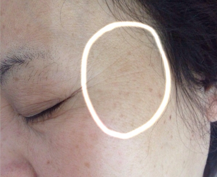 美克拉系统：皱纹为什么那么难去除，皮肤管理中心是如何除皱的