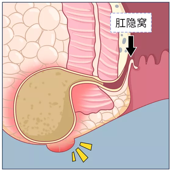 肛周膿腫假性癒合圖片(肛周膿腫自行潰破) - 赤虎壹號