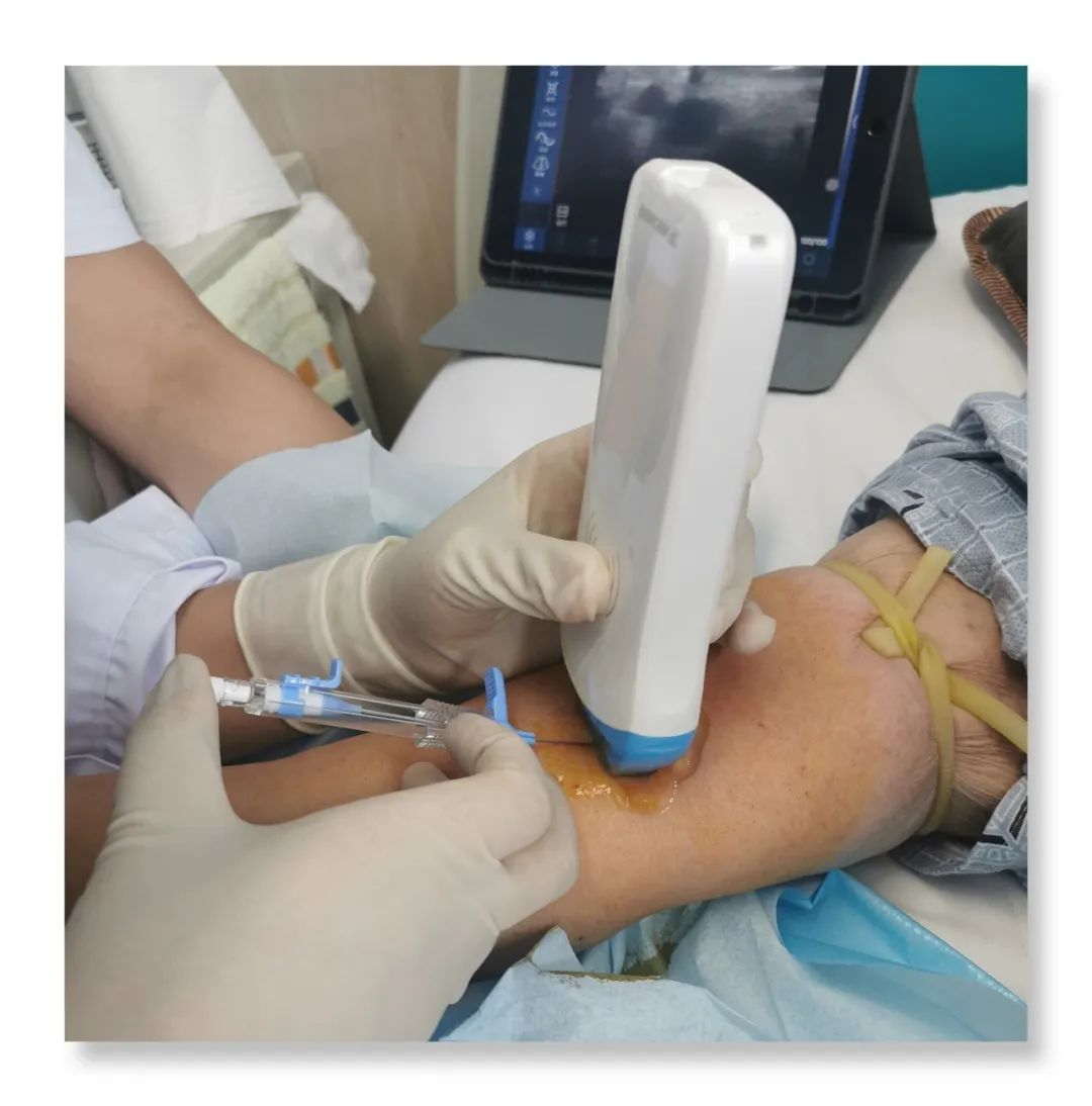 渭南市第二医院普通外科:迷你中长导管 为患者带来福音