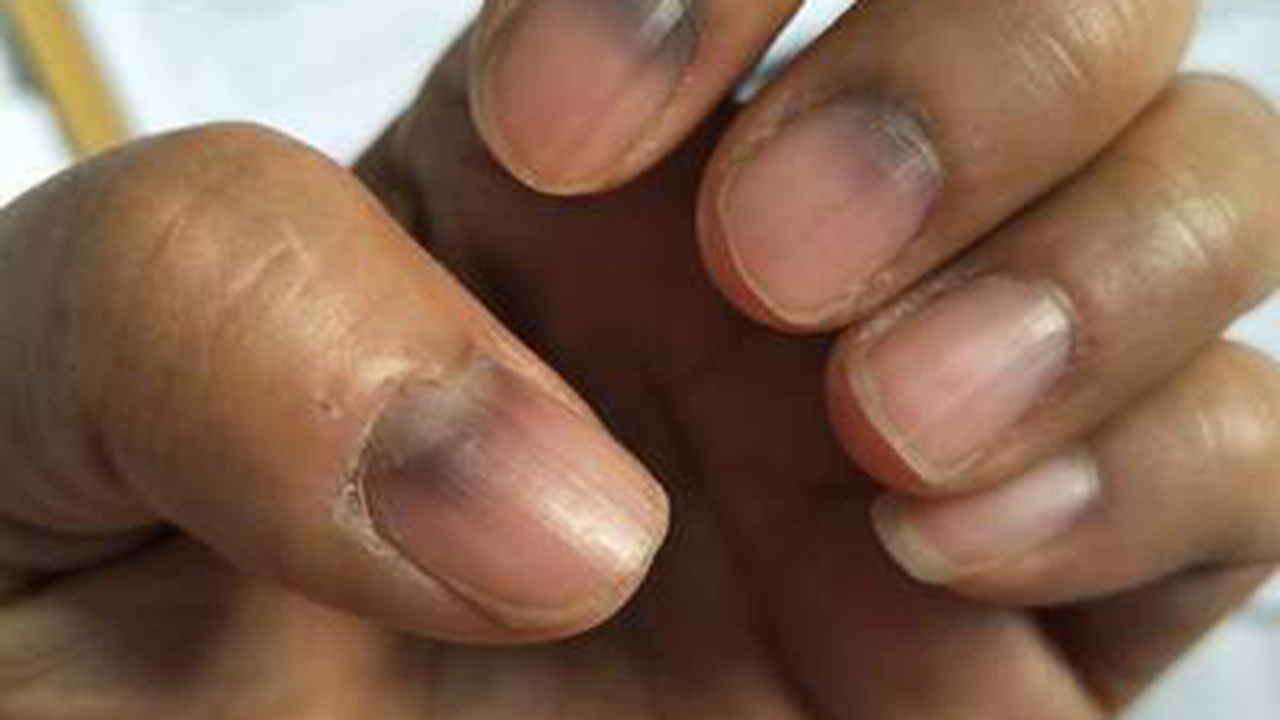 提醒:指甲若长成4种样子,可能是癌或疾病的信号,还请留心观察