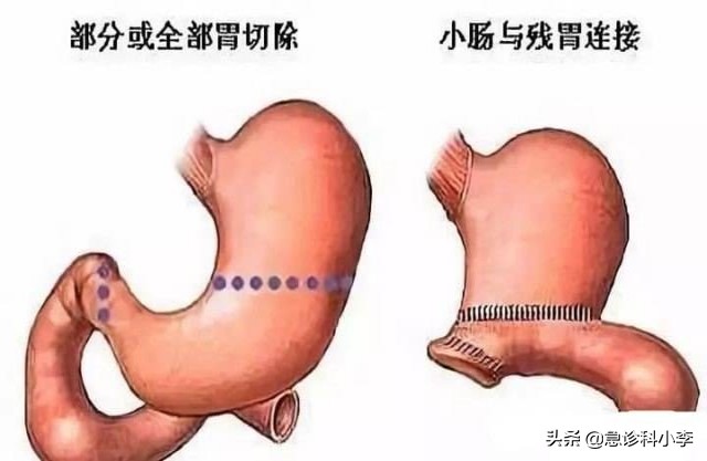 体内缺维生素B12，身体会出现哪些症状？吃什么补充？应该了解下