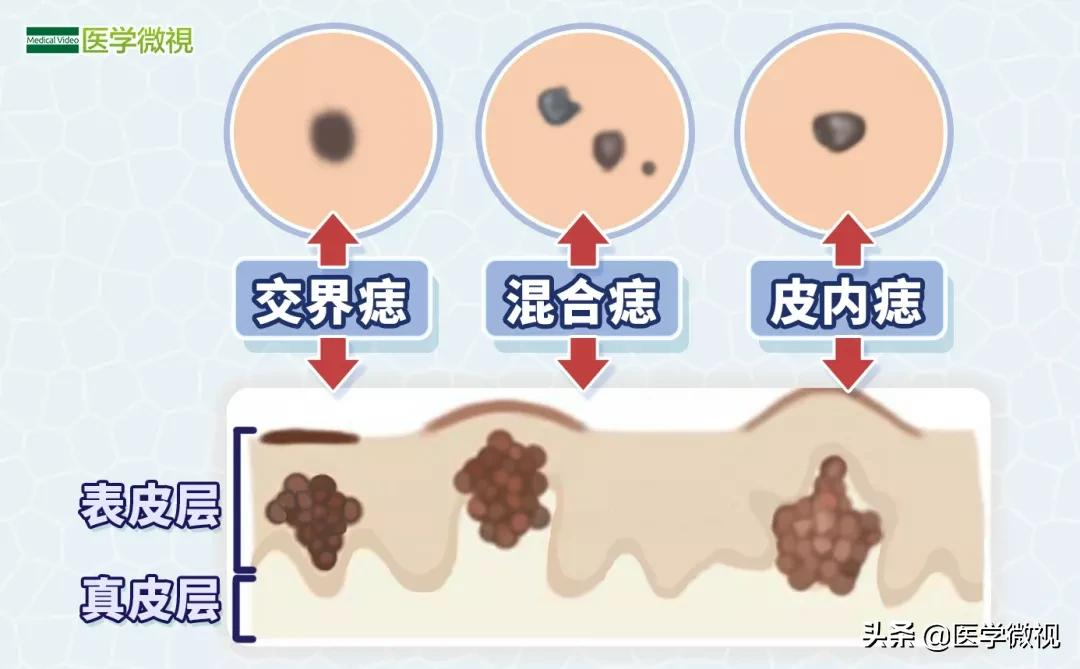 18岁少年“点痣”复发竟成癌！关注这几点，简单判断痣的良恶性