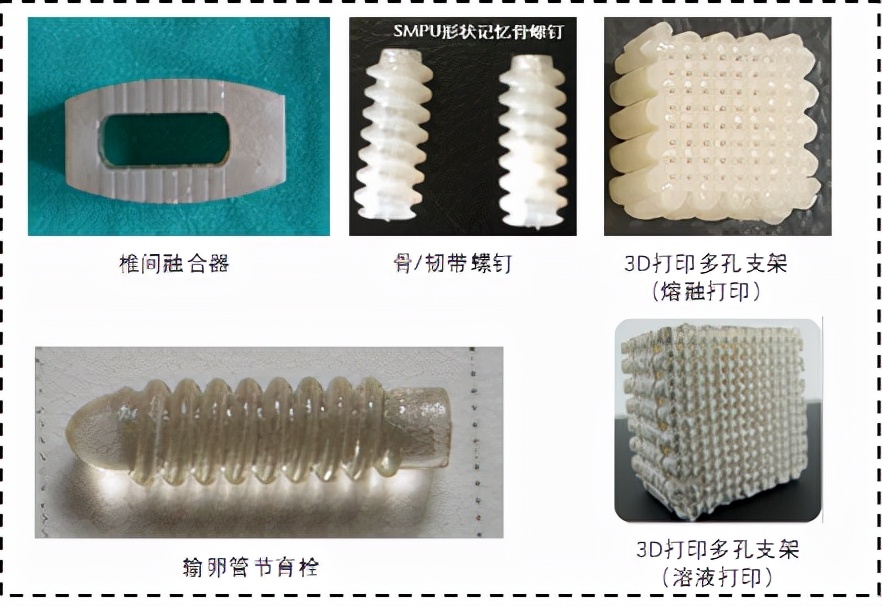 骨科患者的福音，重庆大学新型形状记忆材料可微创植入、体内降解