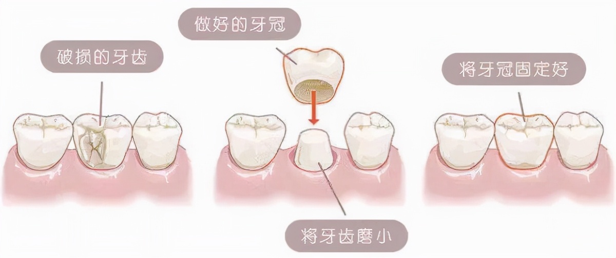 亮瞎眼！明星烤瓷牙变灾难，嘴包不住牙、嘴凸、变老、演戏难看