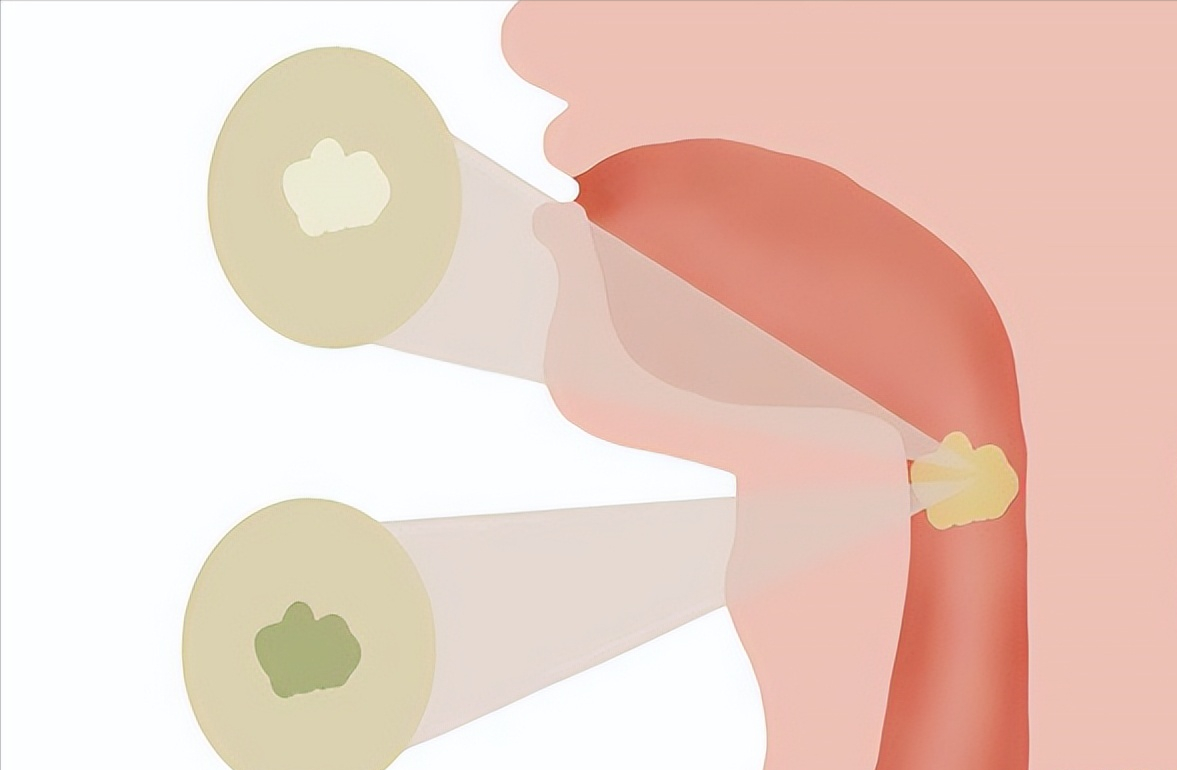 俗话说“黄痰轻，黑痰重，白痰要了命”，是真的吗？揭开痰的秘密