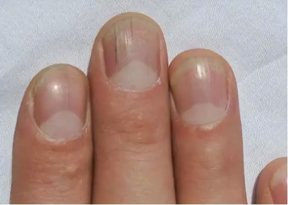 如果发现自己的指甲出现了竖纹且呈非正常颜色,如浅褐色,黑褐色等