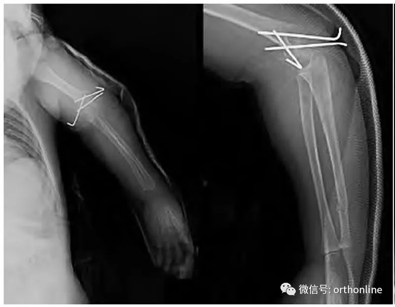 儿童肱骨髁上骨折合并同侧孟氏骨折1例报道