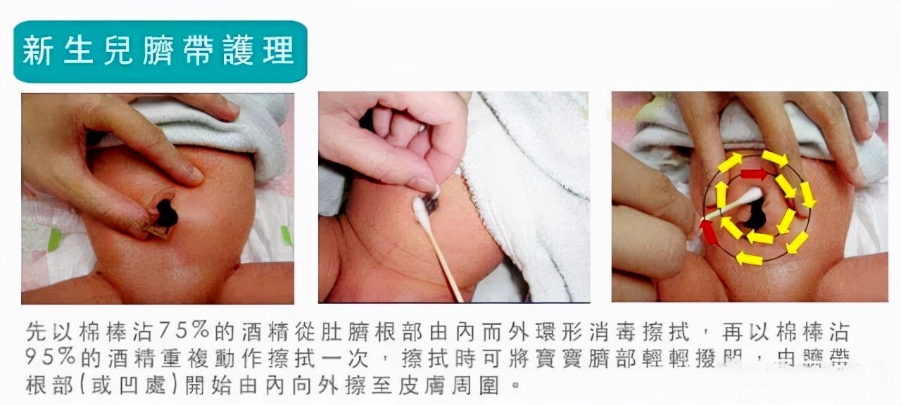 新生儿脐带如何护理，残端脱落后还需要护理吗？很多家长做错