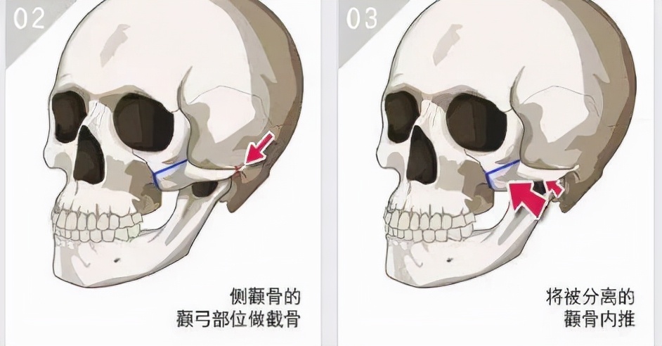 如何快速区分颧骨和苹果肌？ 苹果肌和高颧骨各有各的美
