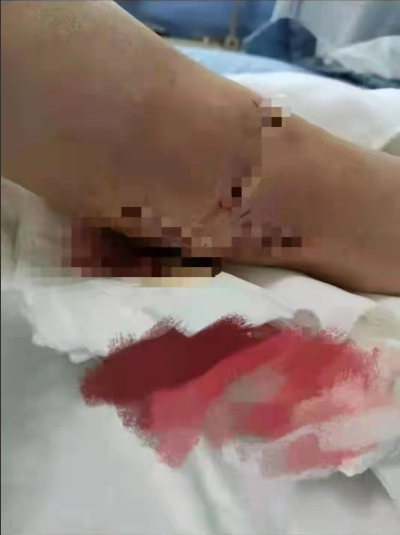 四川一“楼长”学姐查零食，13岁女生被罚150个下蹲，致终身残疾