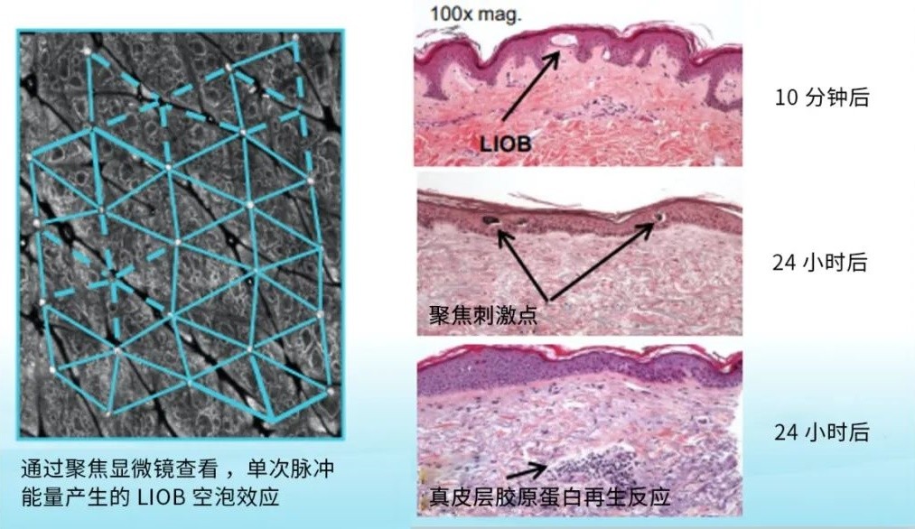 赛诺秀旗下明星产品蜂巢皮秒正式推出新昵称“755原生皮秒”