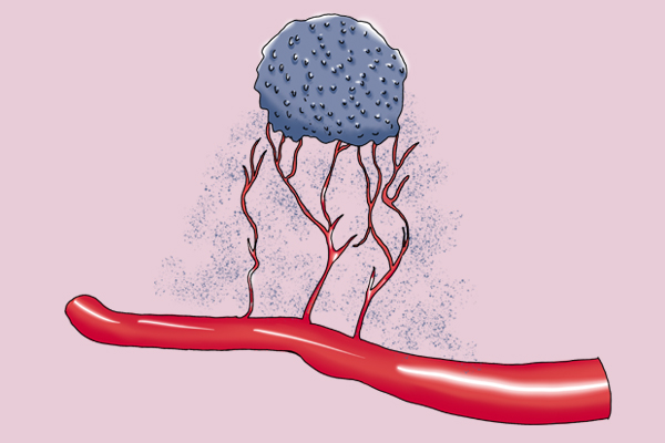 备受争议的3种“癌”不致命，不建议过度治疗，假如你有，别紧张