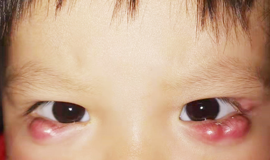 1岁小女孩眼部连长多个脓包，家长误以为是“水肿”