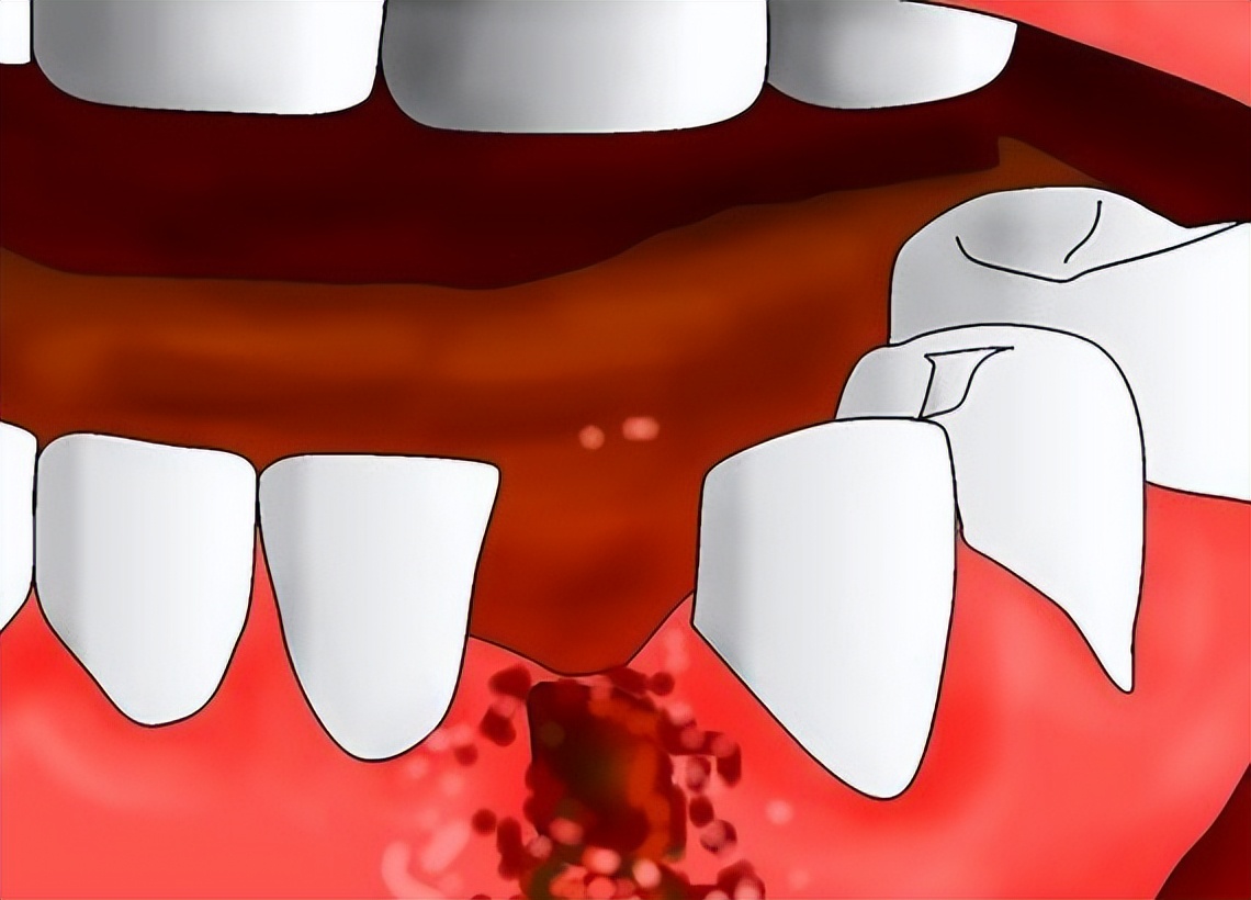 拔牙后出血形成的血凝块像果冻一样,可保护创口,防止出血,感染,促进