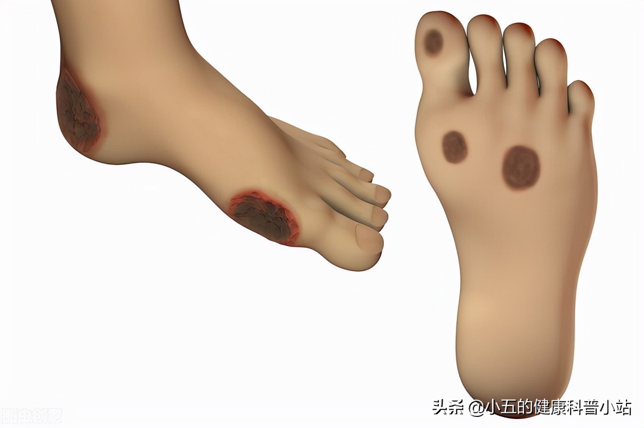 长期糖尿病引起血管损伤怎么办？合理使用4种药物，帮你保护血管