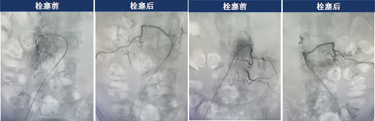 55岁腰椎体转移瘤患者急需手术 肿瘤供血动脉栓塞术保驾护航