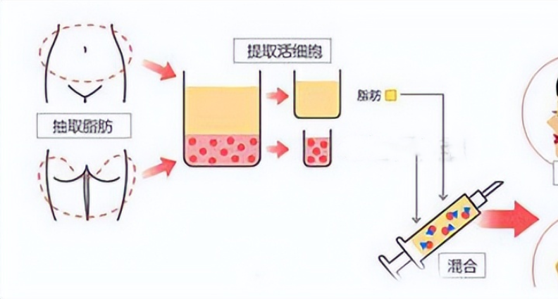 面部填充材料都有什么？哪种效果自然啊？术后多久能恢复？