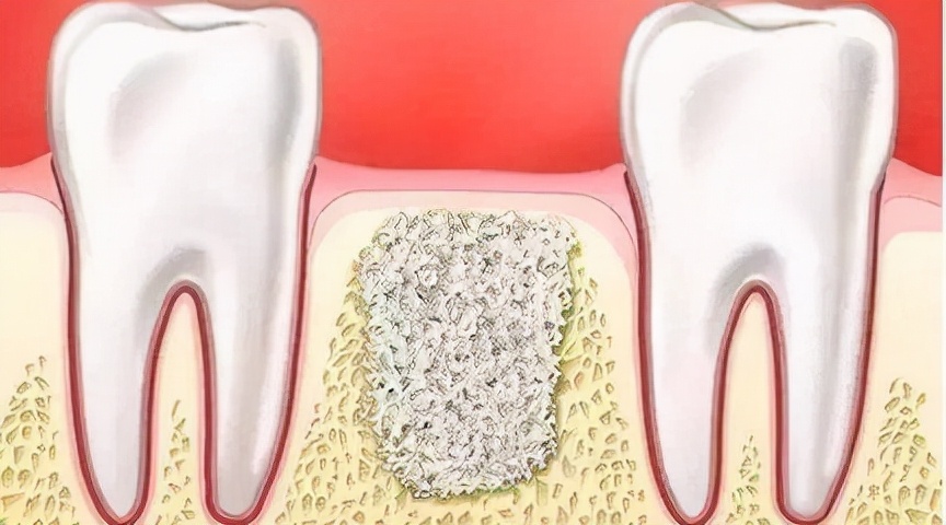 70丨种植牙前植入骨粉会发低热,这是为什么