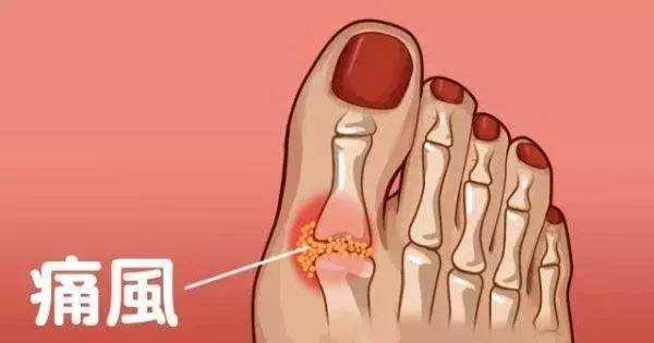 痛风，是不是被吃出来的？别再被折磨了，降尿酸试试这4招